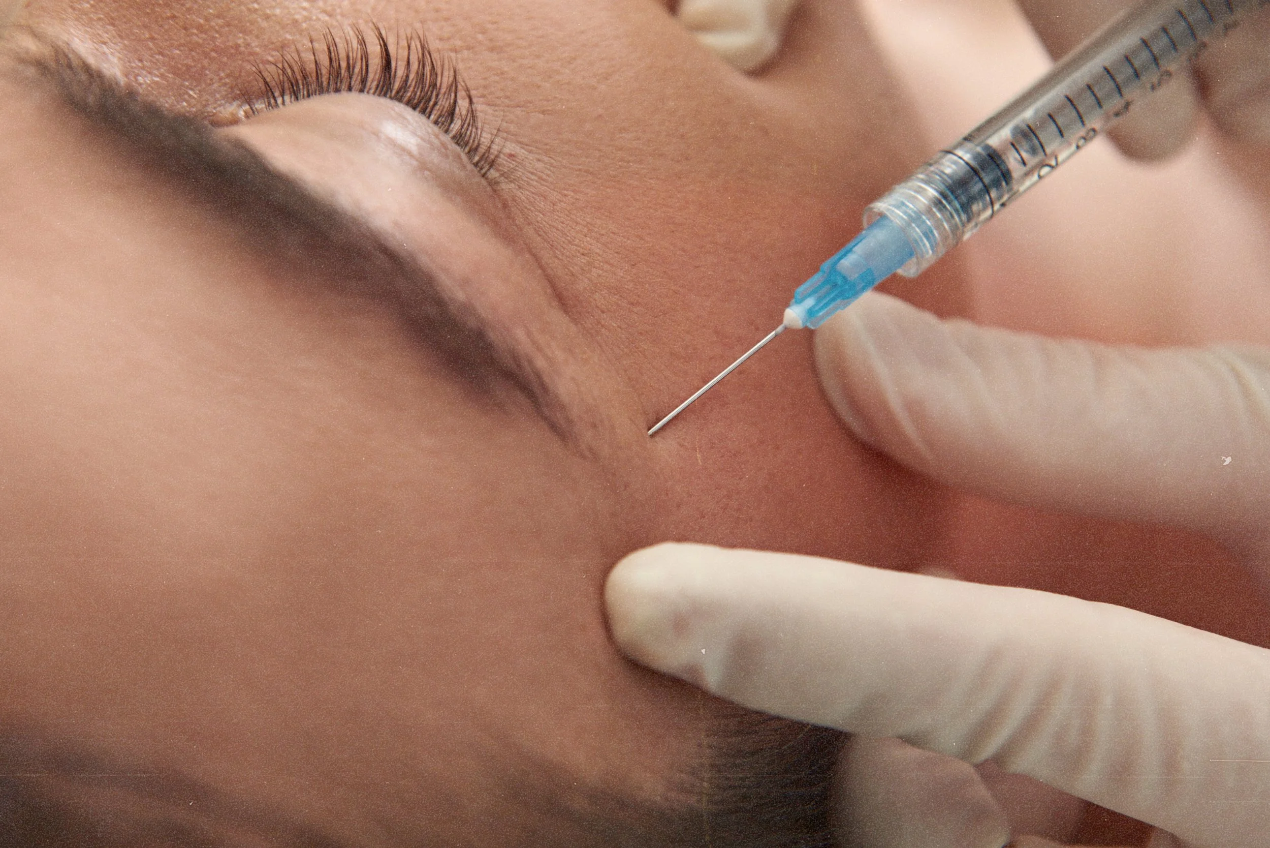 Botox injection to reduce crow's feet wrinkles around the eyes in Birmingham.