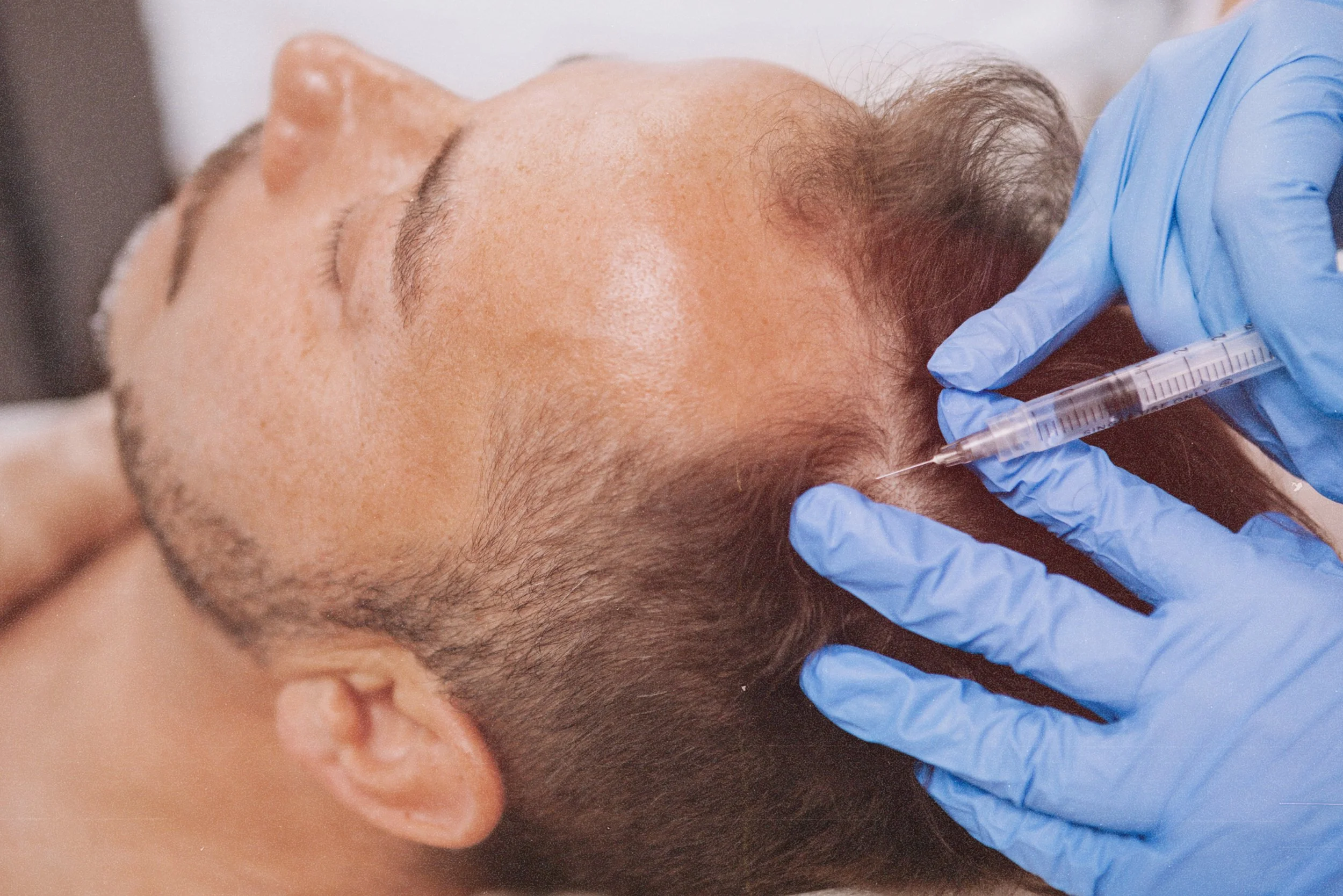 PRP therapy for hair loss stimulation in Birmingham hair transplant clinic.