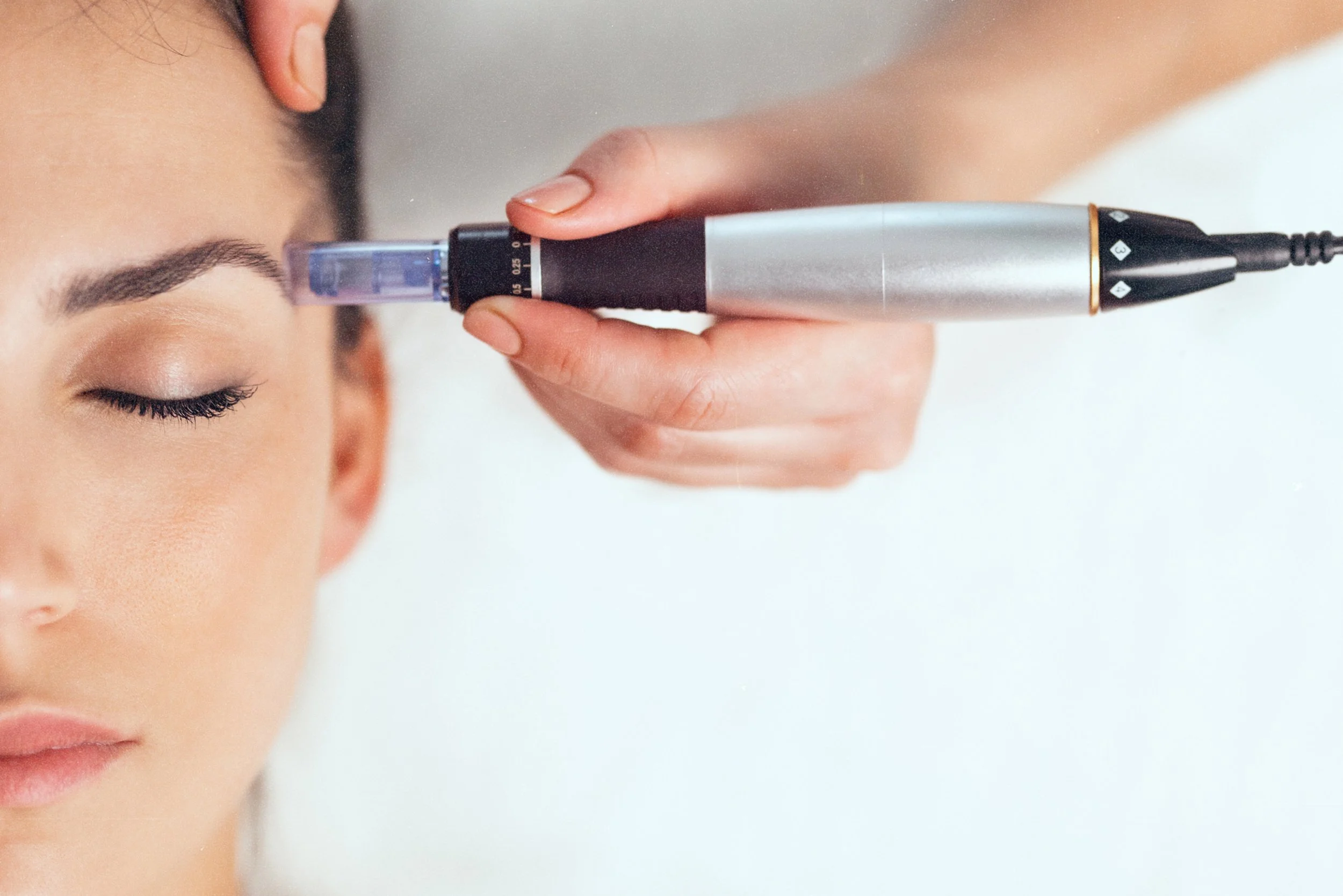 Microneedling session for improved skin texture and reduced scars at Birmingham aesthetics clinic.