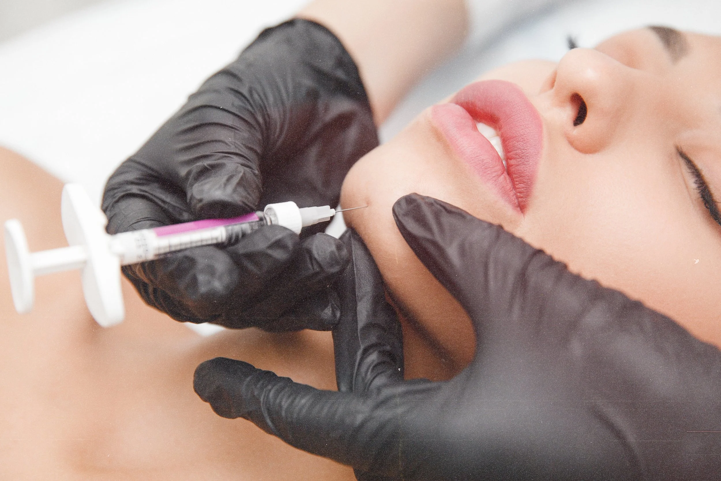 Chin enhancement with dermal fillers for balanced facial profile in Birmingham.