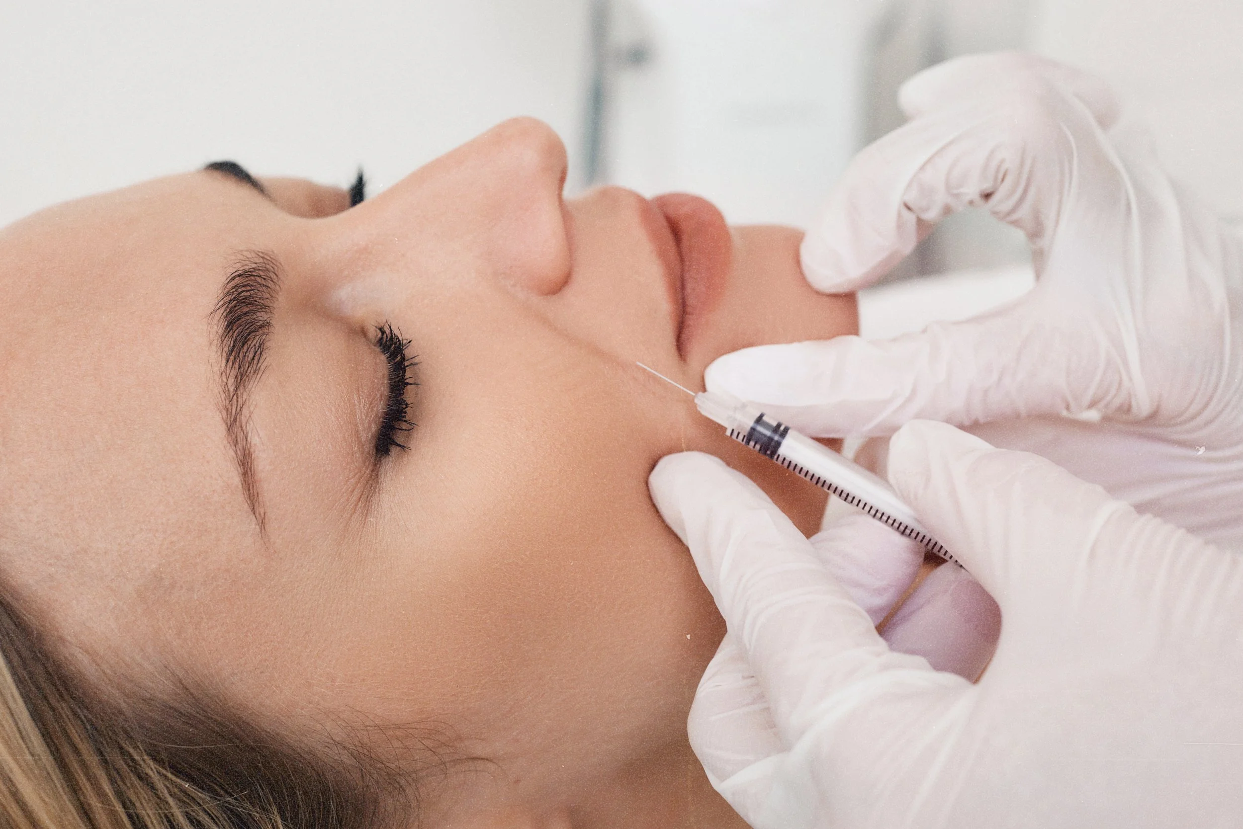 Filler treatment for nasolabial folds by expert Birmingham aesthetic team.