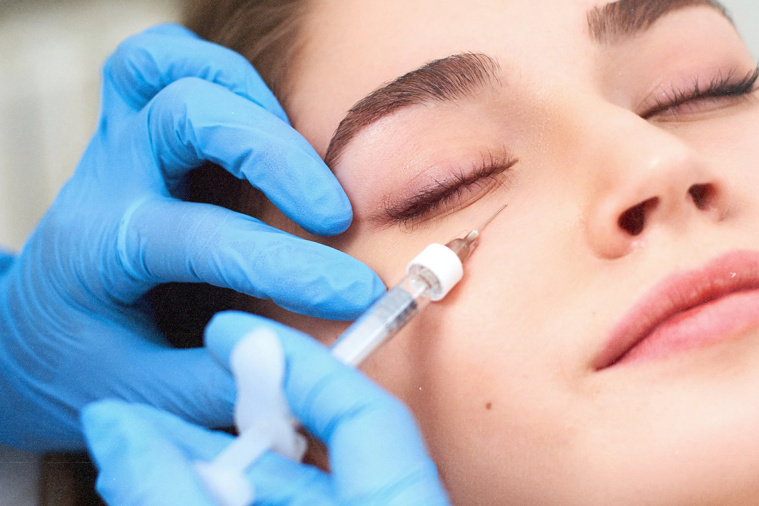 Under-eye filler treatment for tear trough correction in Birmingham.