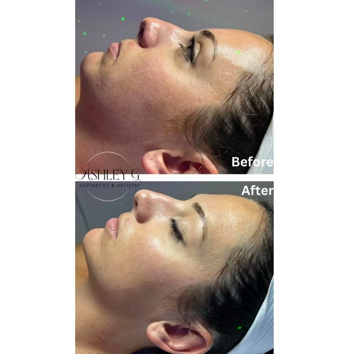 We are going for snatched &amp; glowing skin this holiday season ✨🎄 
Beyond Botox Facial is the must have of the season. Includes a dermaplane, lactic acid peel, and firming peptide mask. Enjoy steamed towels, warm massage, Celluma LED light therapy