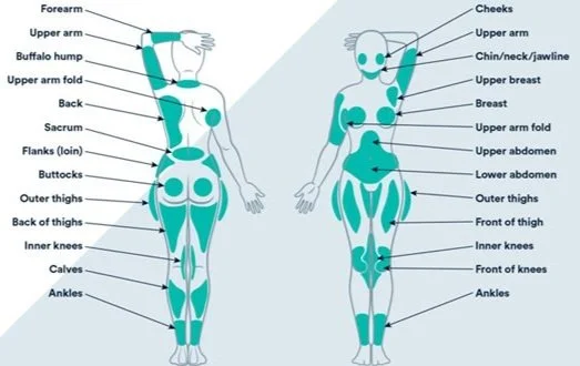 Liposuction Areas.jpg