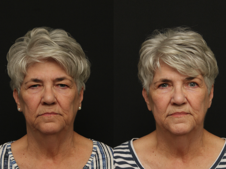 Patient 102: Upper eyelid lift