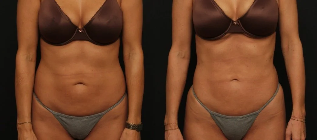 Patient 301: Awake liposuction and skin-tightening treatment