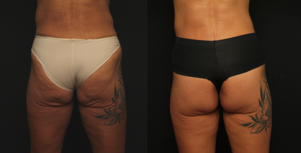 Patient 302:  Posterior lift