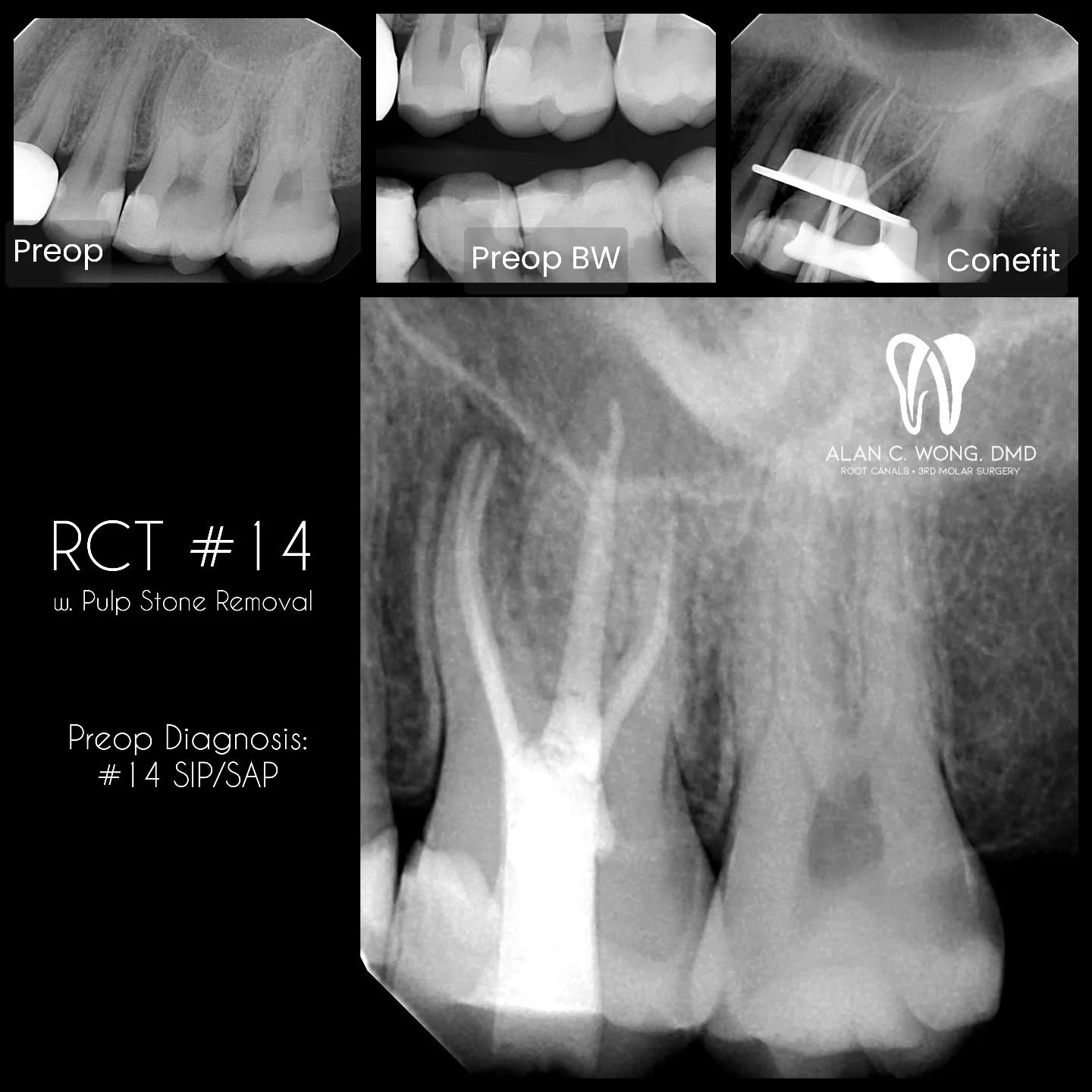 #14 RCT with Pulp Stone Removal
4 PONs / 4 POEs
#endodontics #endodoncia #endodontia #rootcanal #rootcanals #dentistry #mb2sdays #generaldentist #tratamientodeconducto #tratamentodecanalradicular #edgeendo #texasdentist