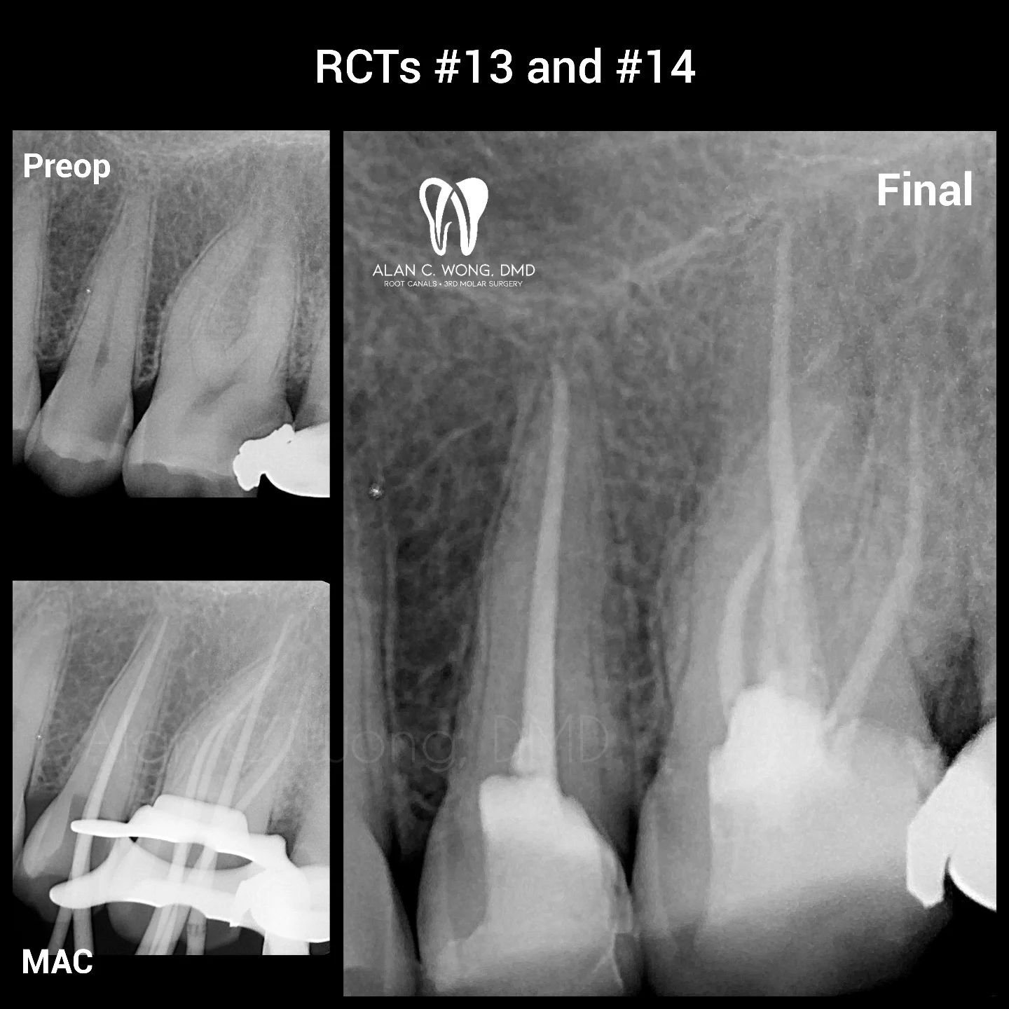 RCTs on #13 (UL5) and #14 (UL6)
Overall happy with the result. Six "canals" were found and instrumented - 2 PONs in #13, while #14 had 4 PONs.
Went a bit mesial on the premolar than I'd like. Cases like this encapsulate the practice of de