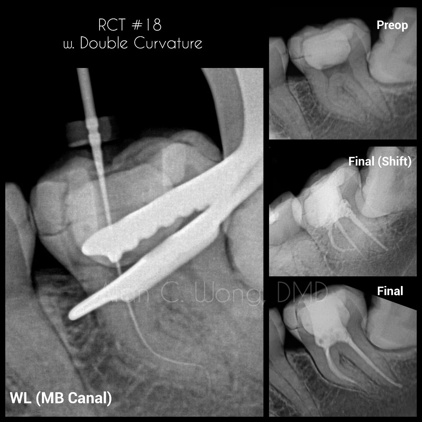 #18 RCT with multi-planar curvature in the MB canal.
Dx: #18 SIP/SAP
Access made through provisional crown. Can't imagine managing cases like these without heat treated rotary files. This is also another example of the anatomical apex being differ