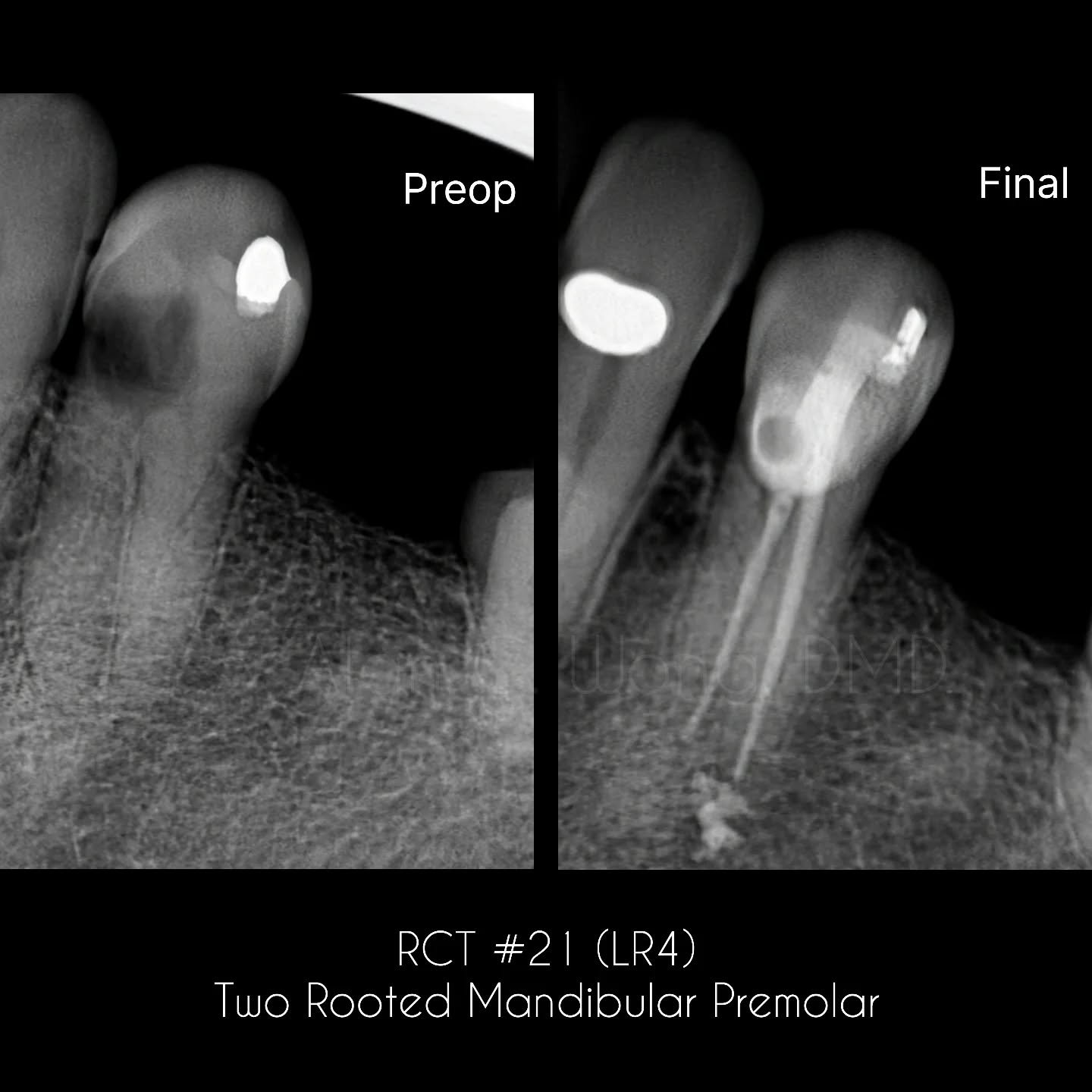 Let's be honest, not every procedure we perform is going to come out perfect.
I performed an RCT on this two rooted mandibular first premolar. Used a two-prong approach with access - caries leveraged access on the buccal to directly visualize the b