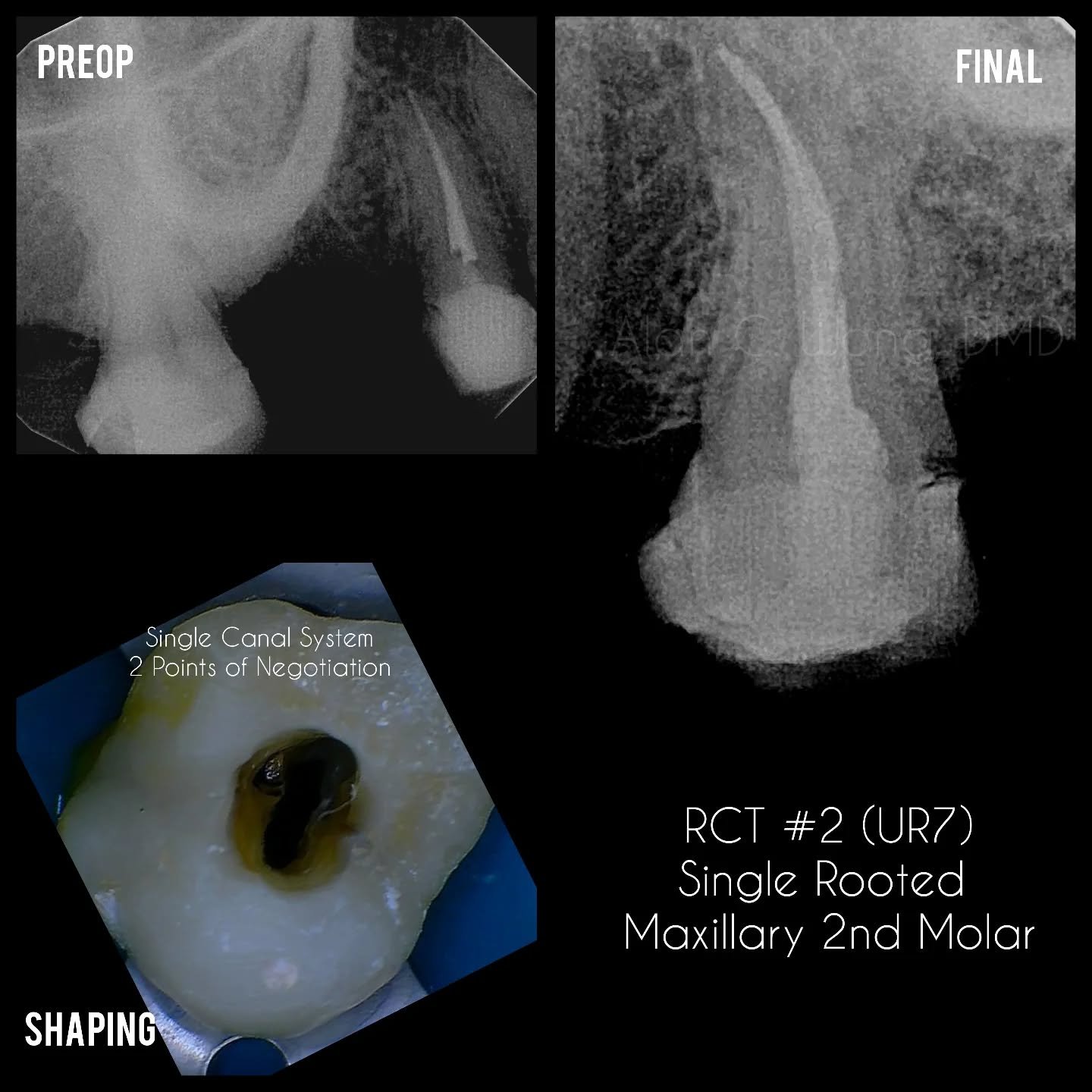Beware the "Single Canal" 2nd Molars
Not something you see everyday
It's tempting to think these RCTs are easy. Bear in mind the cross sections of these canal systems can be irregular. Treating them like a single canal can result in instr