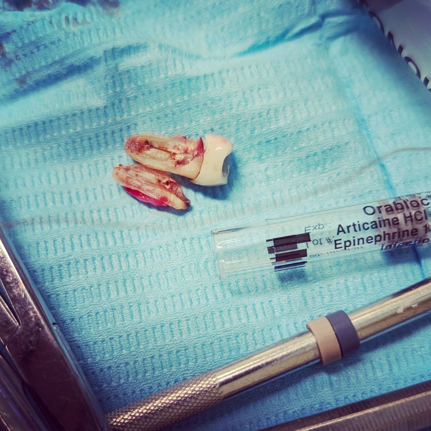 Unfortunately, not all teeth are amenable to endodontic treatment.
This 2 canaled lower premolar had the initial RCT done years ago, then a retreat later on. I believe the retreat involved removing a separated file and further shaping of the 2nd can