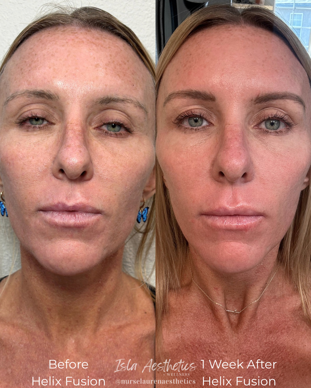 Before Helix Fusion.PNG