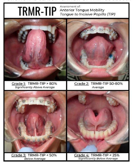 Dental images showing the assessment of anterior tongue mobility with four grades indicating different levels of TRMR-TIP scores, from grade 1 to grade 4.