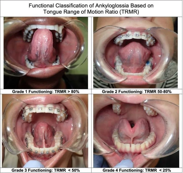 Diagram showing four grades of ankyloglyossia classification based on tongue range of motion ratio, with images of mouth and tongue in each grade.