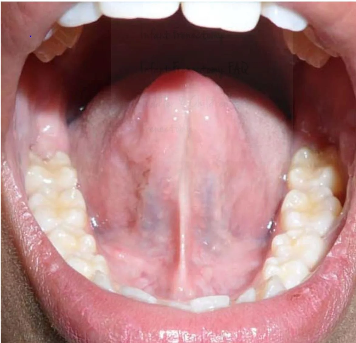 Close-up of an open mouth showing the teeth, tongue, and inner cheeks.