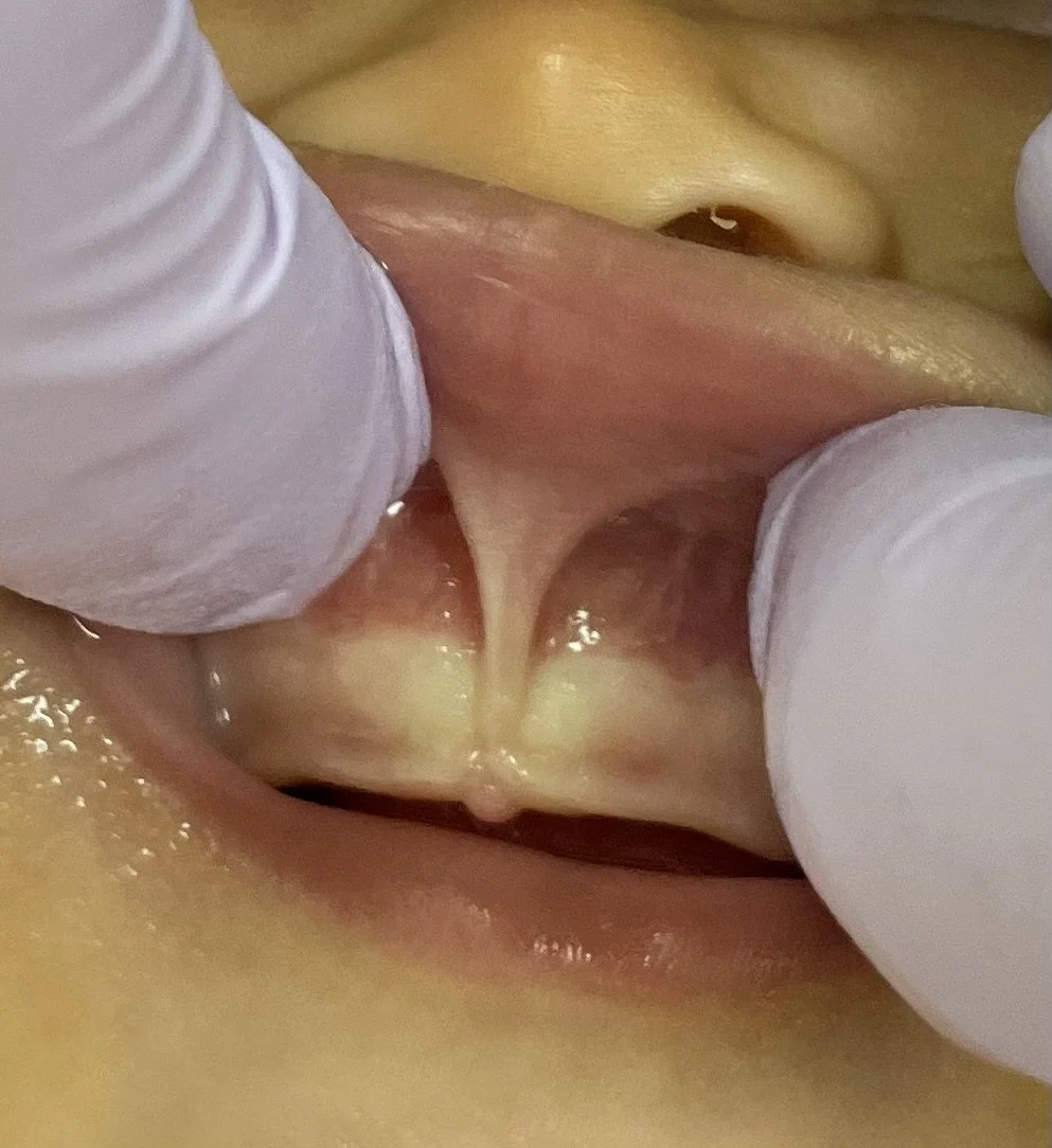 tongue tie lip