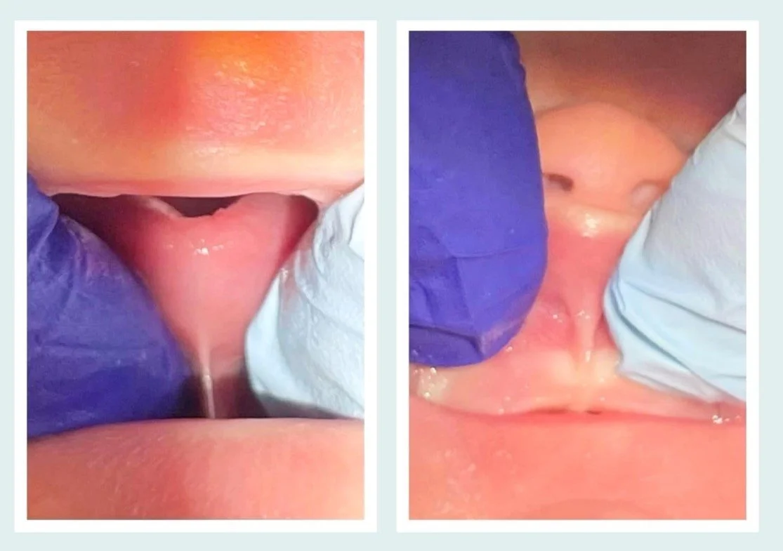 infant tongue tie