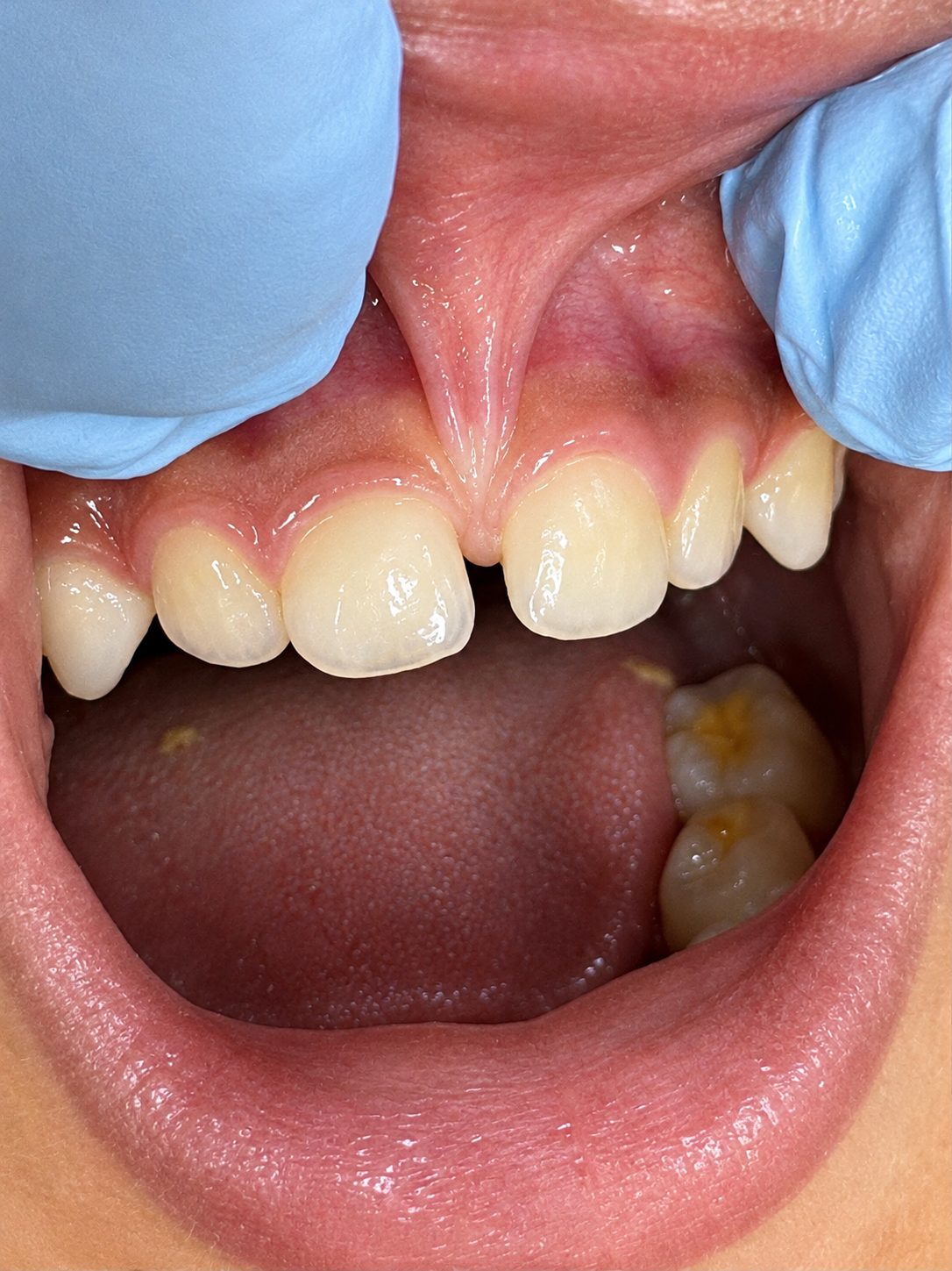 Dr Bunt lip tie