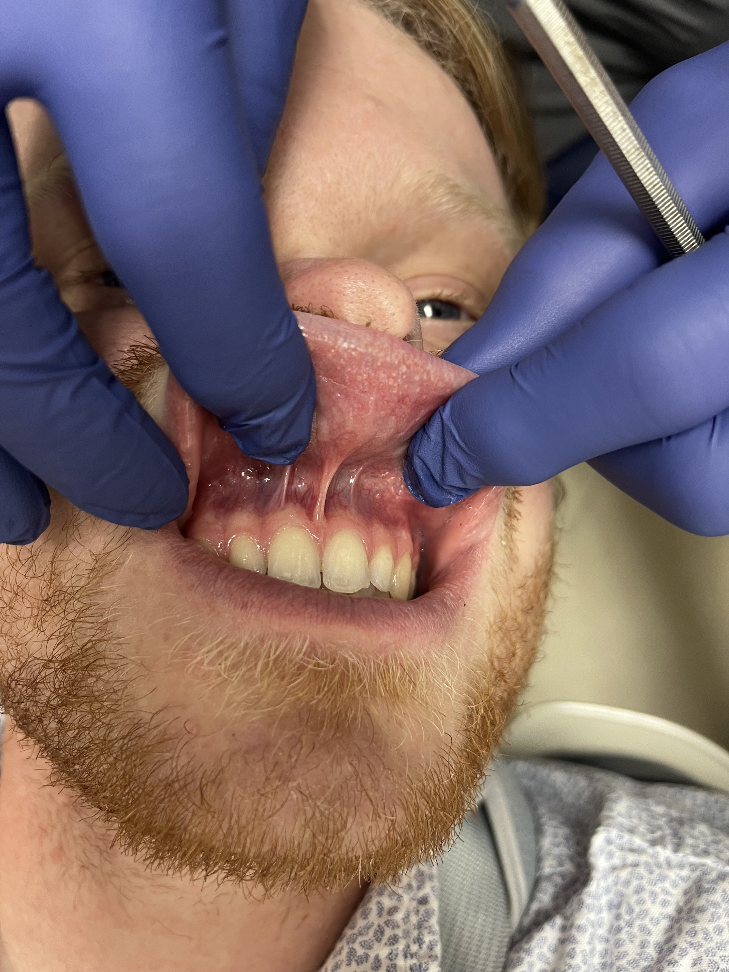 adult lip tie