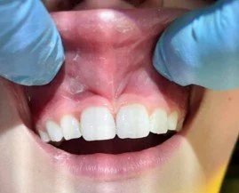 Close-up of a person's open mouth showing upper front teeth and gums, with a healthcare professional wearing blue gloves gently pulling the lips back.