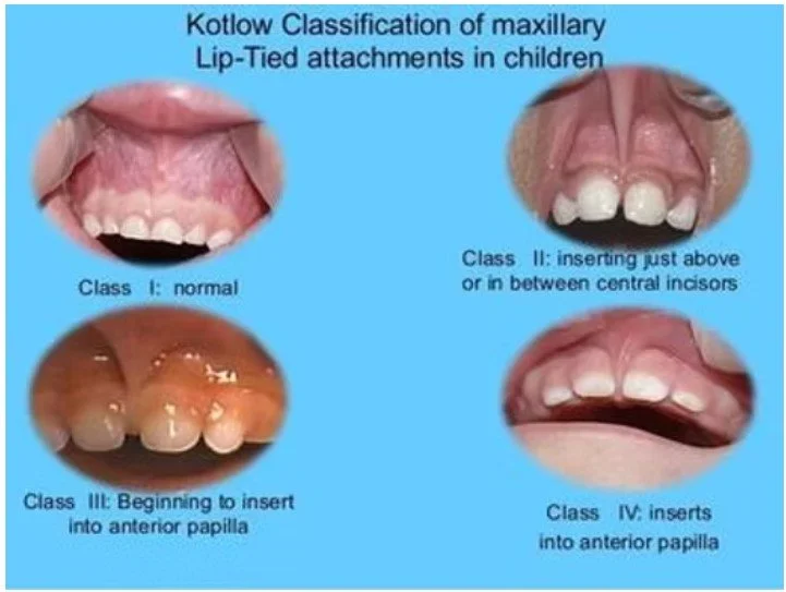Diagram showing Kotlow classification of maxillary lip-tied attachments in children with four classes: Class I normal, Class II inserting just above or in between central incisors, Class III beginning to insert into anterior papilla, and Class IV inserts into anterior papilla.