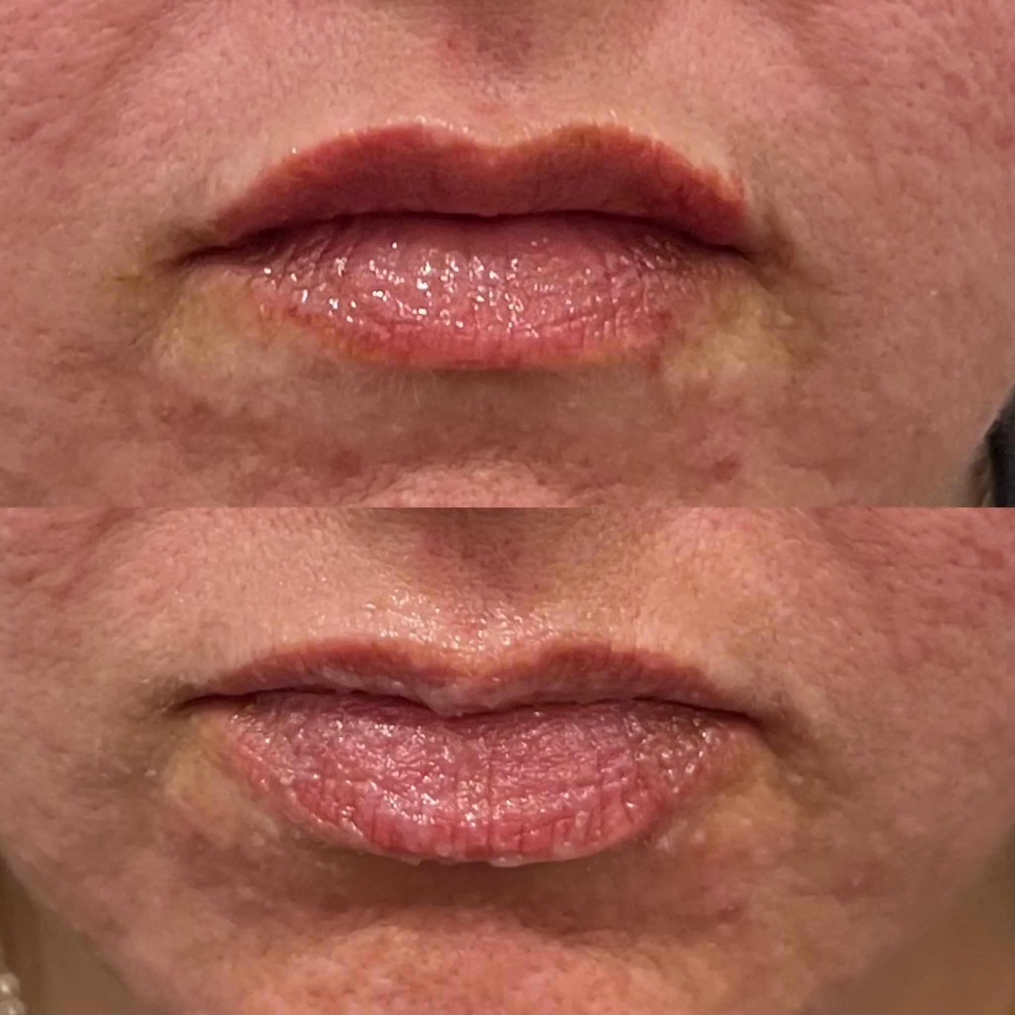 Lip filler in Monett mo