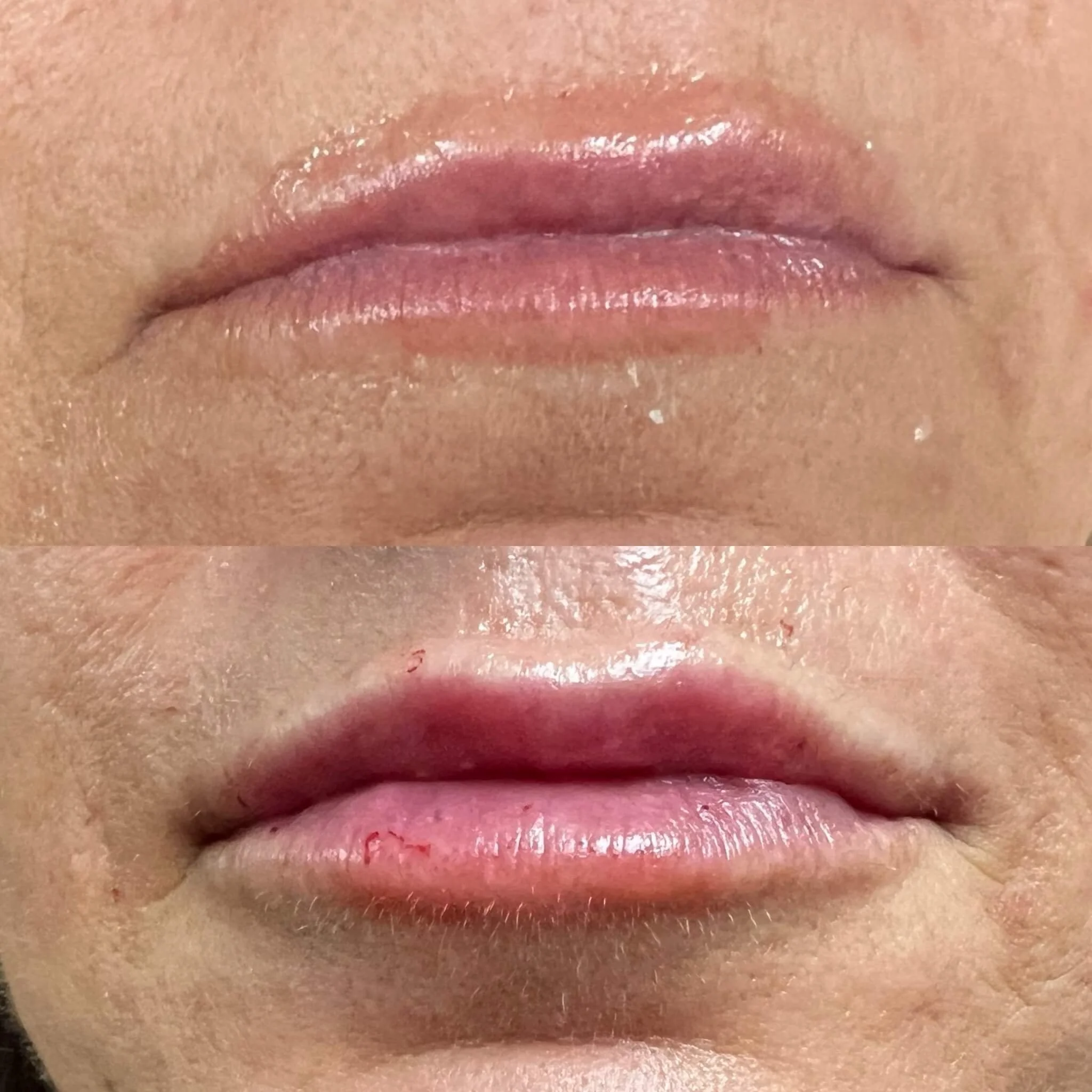 before and after photo of lip filler results