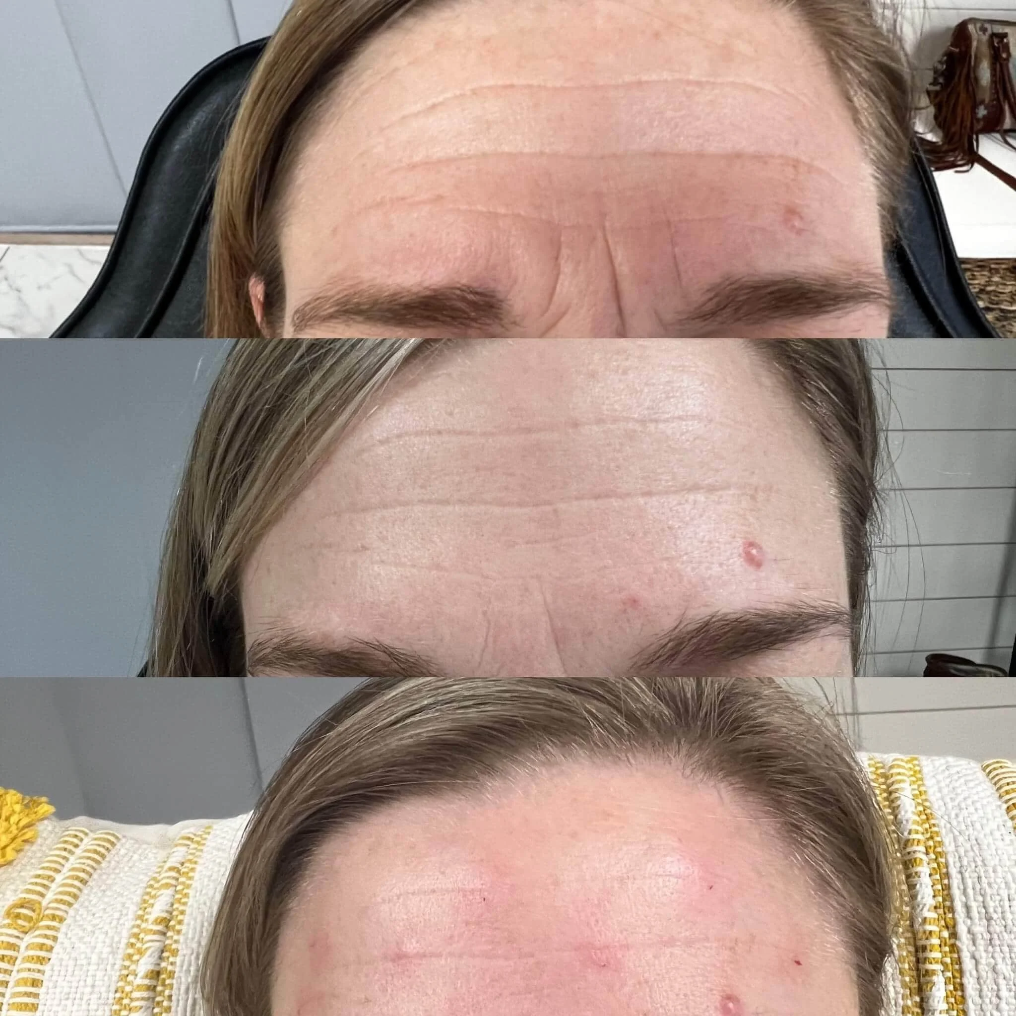 before and after photo of forehead lines treated with Botox