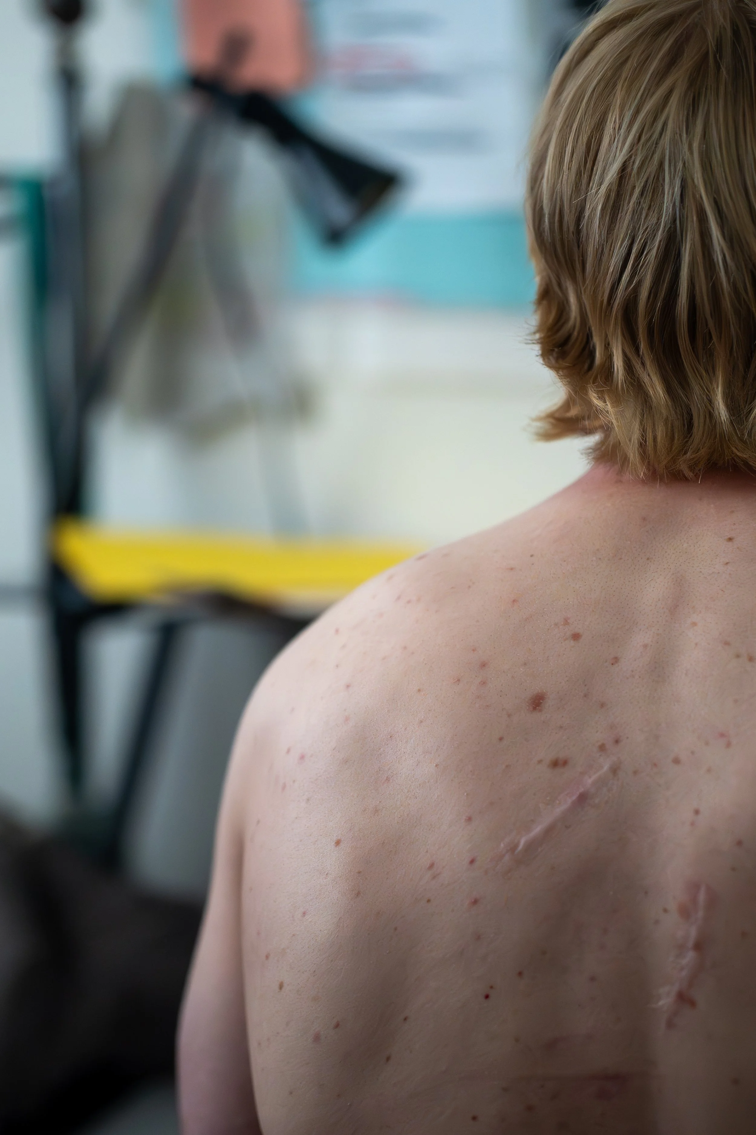 A person with short blonde hair and multiple scars on their back, facing away in a medical setting.