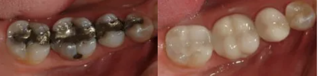 Silver Filings Replaced with White