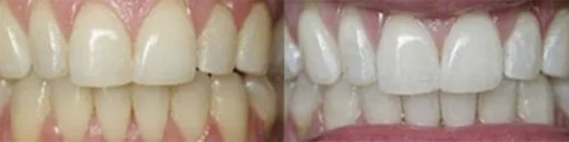 Teeth Whitening