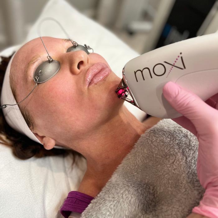 moxi-skin-treatment.jpg