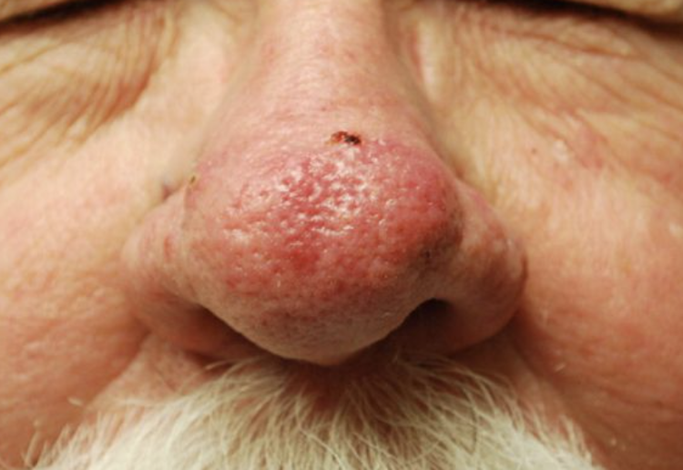 Phymatous rosacea