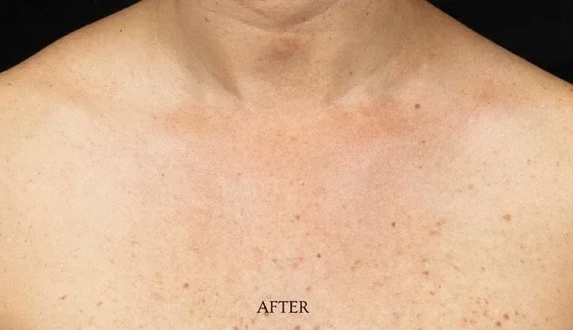 After laser removal treatment photo of a woman’s chest and neck with reduced redness and improved skin clarity