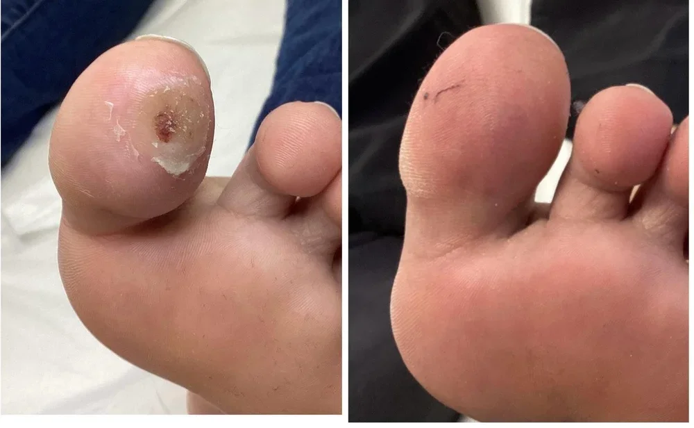 plantar+wart.webp
