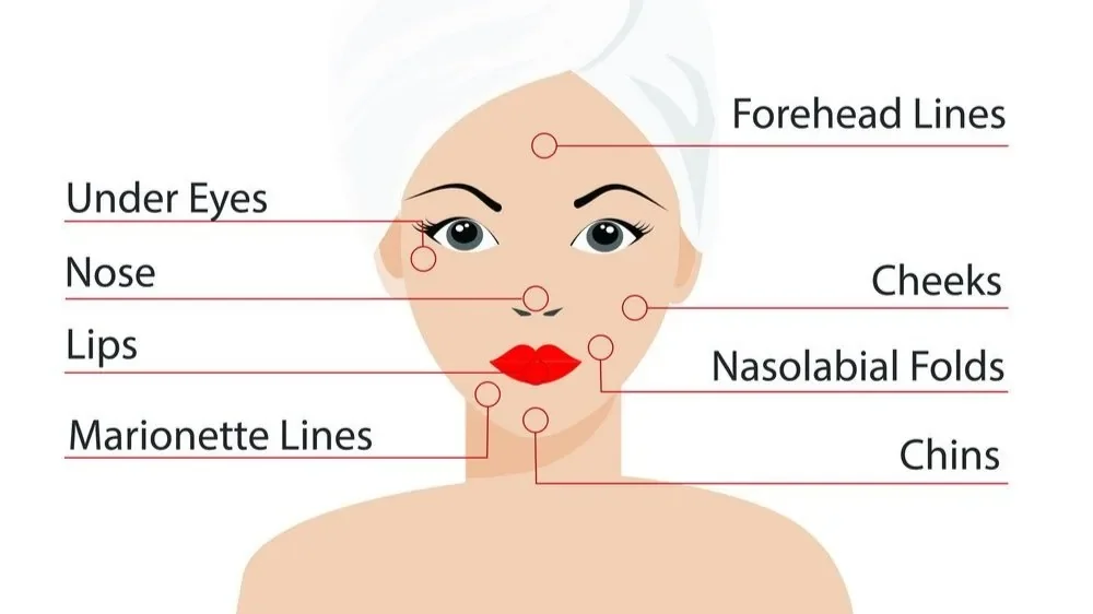 Vector diagram of a woman’s face labeling common facial areas for electrocautery skin lesion and aesthetic treatments