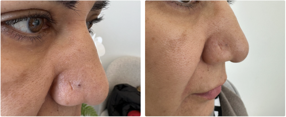 Before and after mole removal