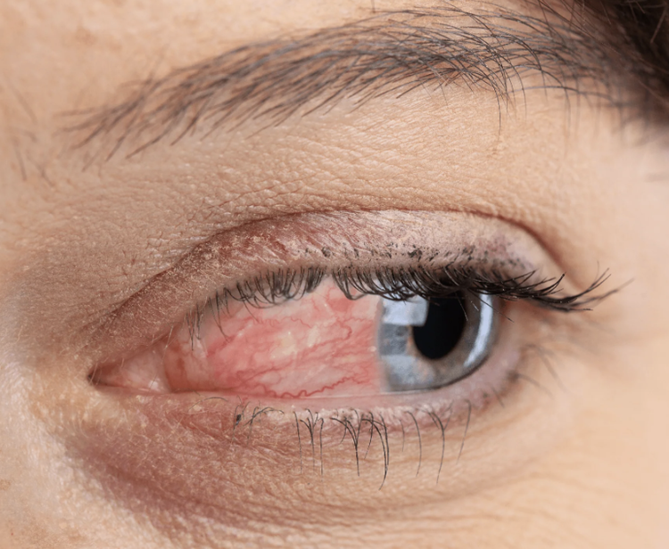 Ocular rosacea