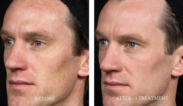 Before and after comparison of a man’s face showing reduced freckles and sun spots after 1 laser removal treatment