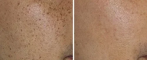Before and after laser removal procedure: close-up of skin showing reduction of sun spots and pigmented lesions