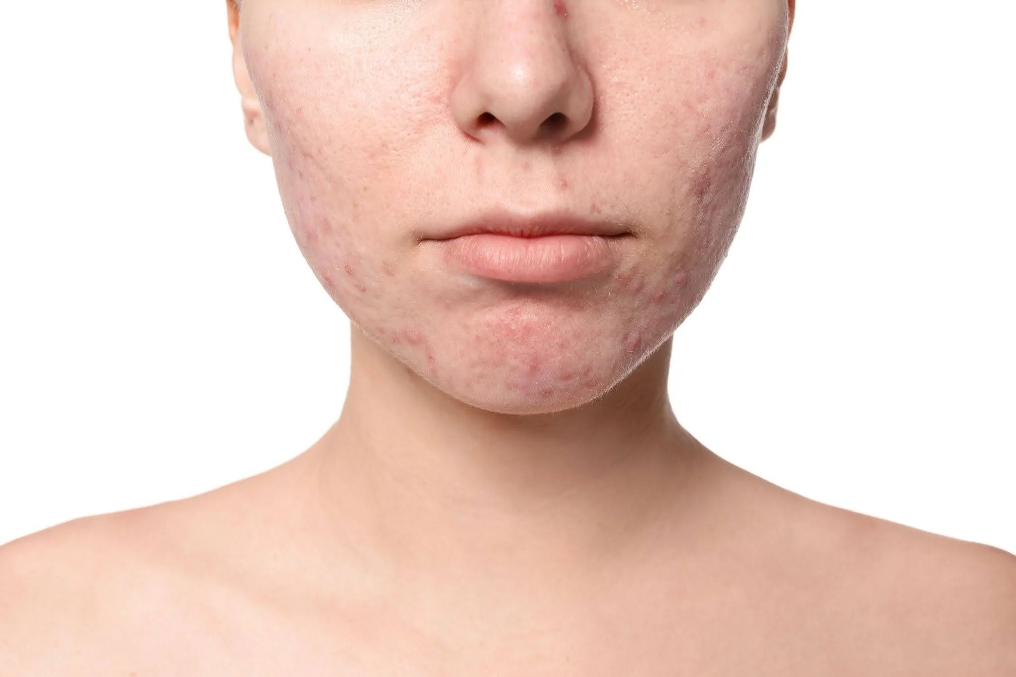 Woman with painful deep inflammatory cystic acne on jawline before cortisone injection treatment