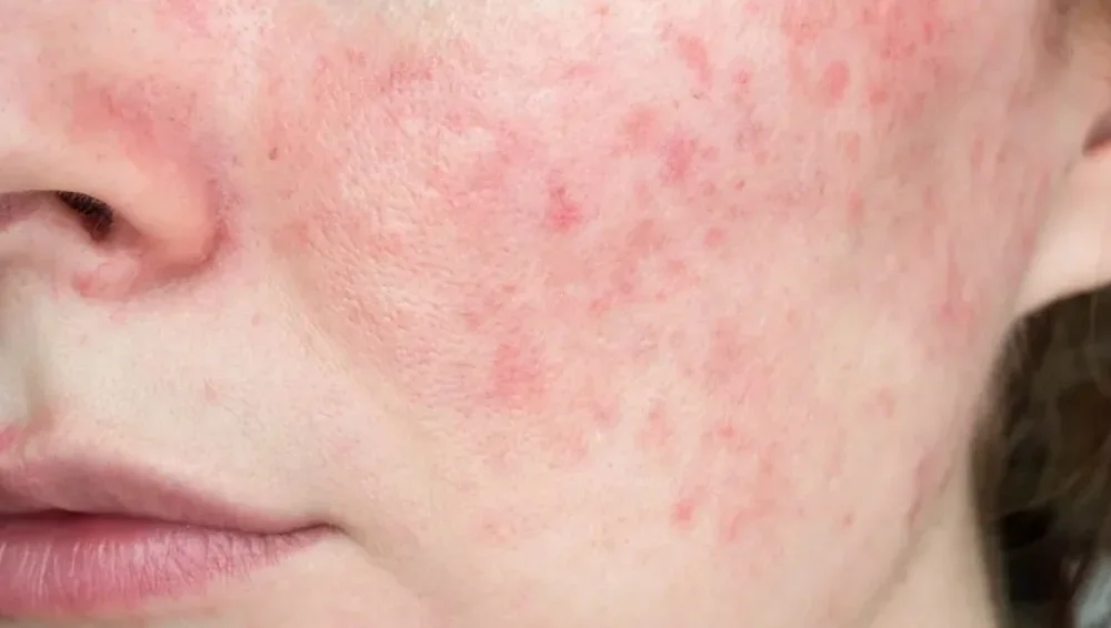 Papulopustular rosacea