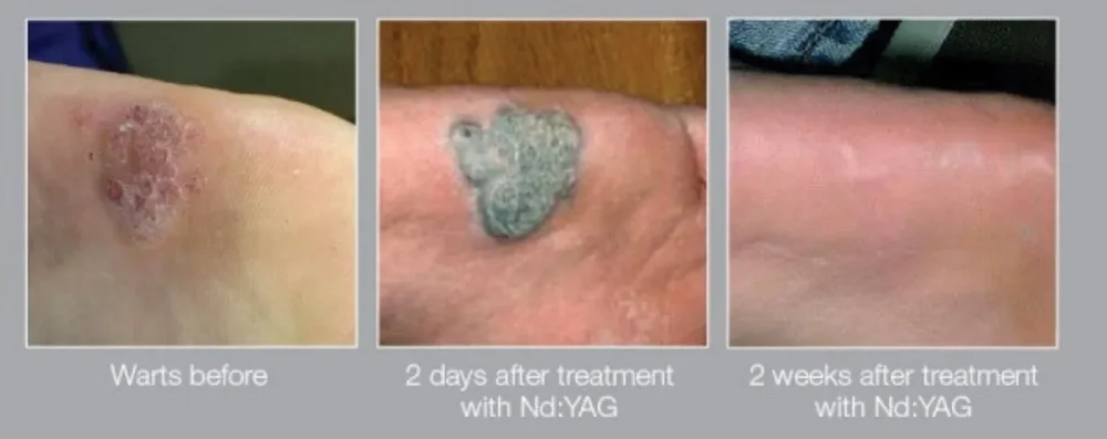 Before and after wart removal