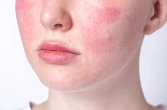 Erythematotelangiectatic rosacea