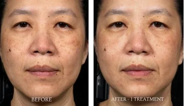 Before and after comparison of a woman’s face showing reduced freckles and a more even skin tone after 1 laser removal treatment