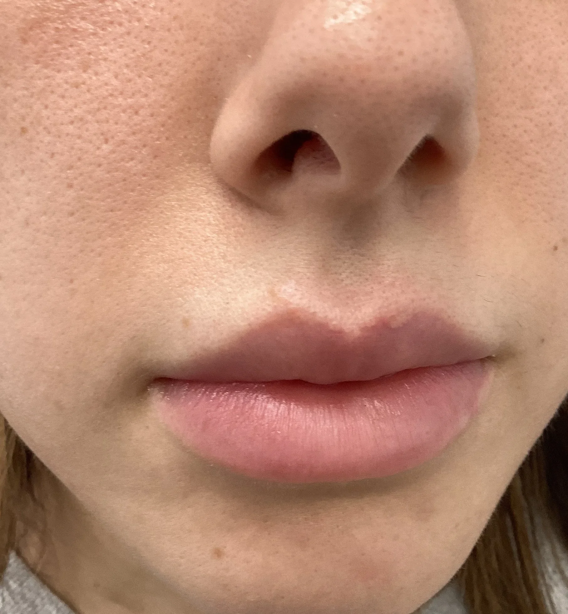After photo showing clear, smooth skin with no mole following electrocautery lesion removal
