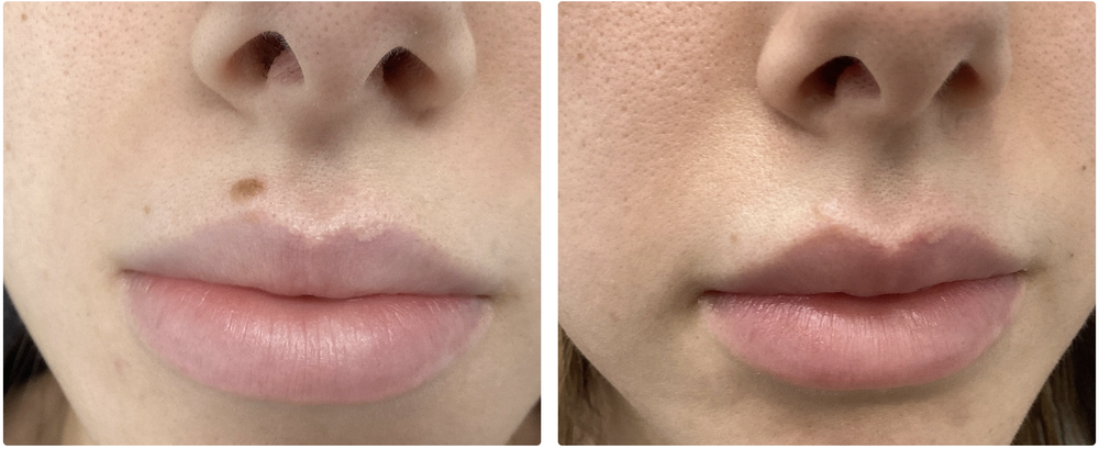 Before and after raised lesion removal