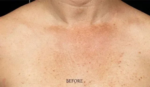 Before laser removal procedure photo of a woman’s chest and neck showing redness, sun damage, and pigmented spots